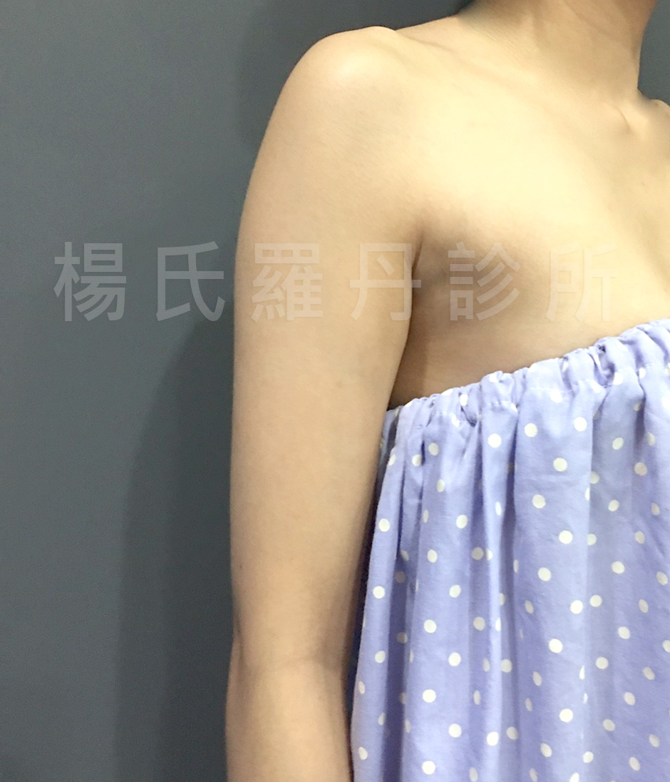 楊氏羅丹雷射減脂